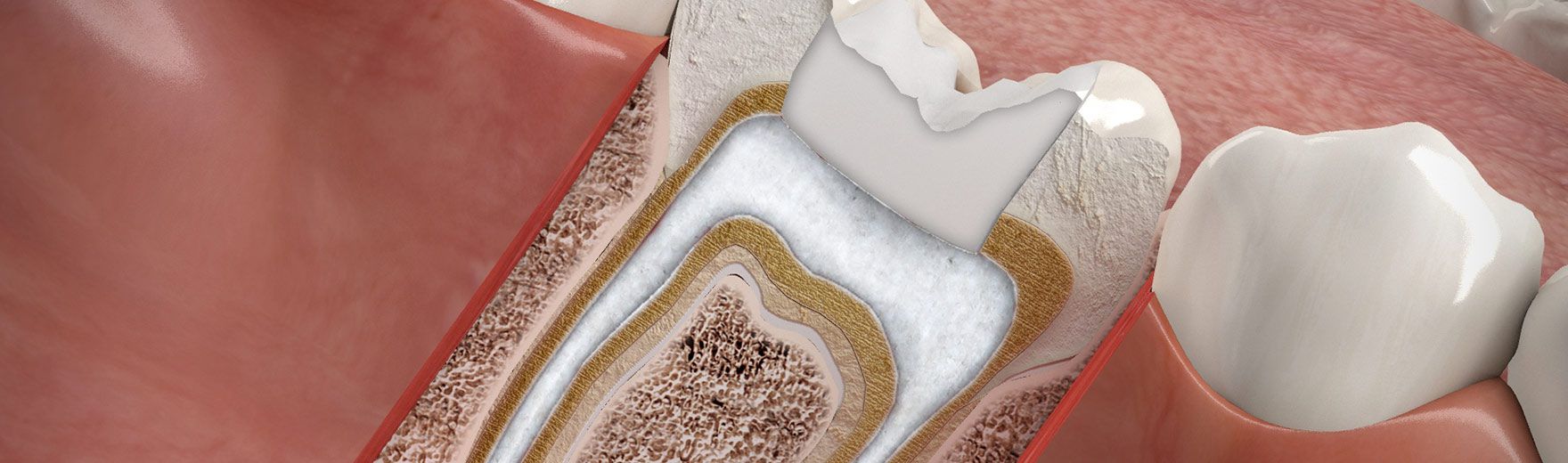 Wurzelkanalbehandlung (Endodontie)